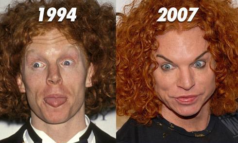 Plastic Surgery Gone Wrong