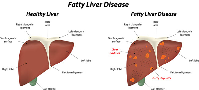Fatty Liver Disease.