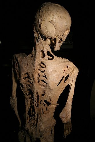 fibrodysplasia-ossificans-progressiva by Joh-co.