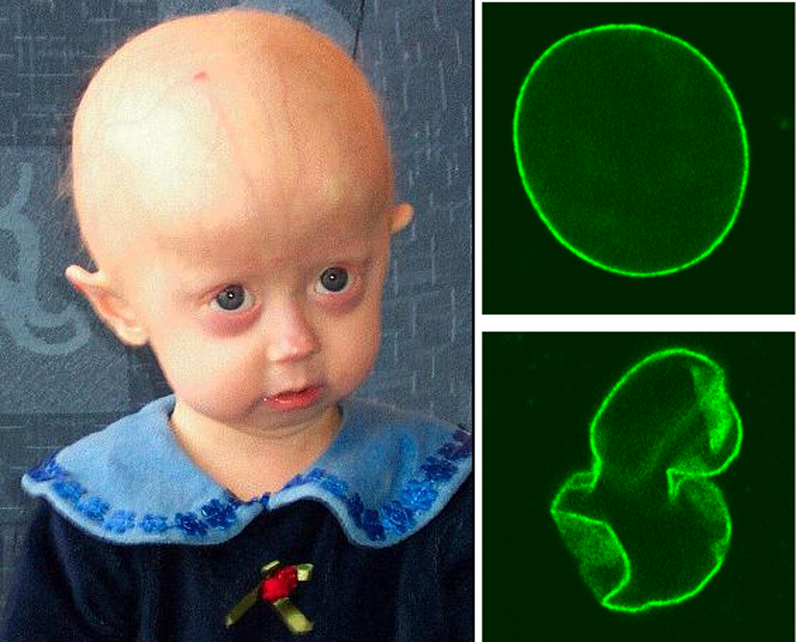 Progeria Syndrome by PLOS.