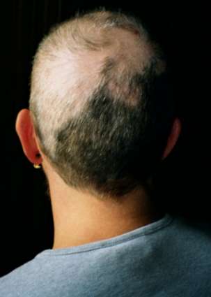 Trichotillomania by Robodoc, de.wiki. Licensed under Public Domain via Commons